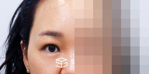 슈가성형외과 첫) 이마거상 + 하안검 + 중안면부거상 전후사진 - 45도 수술 전후 비교