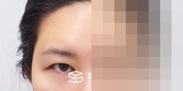 슈가성형외과 첫) 이마거상 + 자연유착 + 뒷밑트임 전후사진 - 정면 수술 전후 비교