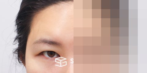 슈가성형외과 첫) 이마거상 + 자연유착 + 뒷밑트임 전후사진 - 정면 수술 전후 비교