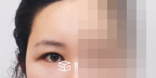 슈가성형외과 첫) 이마거상 + 자연유착 + 뒷밑트임 전후사진 - 45도 수술 전후 비교
