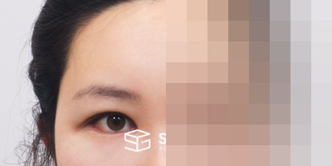 슈가성형외과 첫) 이마거상 + 자연유착 + 뒷밑트임 전후사진 - 45도 수술 전후 비교