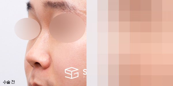 슈가성형외과 첫) 콧대코끝 + 매부리 + 비중격 + 귀연골 전후사진 - 정면 수술 전후 비교