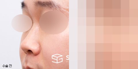 슈가성형외과 첫) 콧대코끝 + 매부리 + 비중격 + 귀연골 전후사진 - 정면 수술 전후 비교
