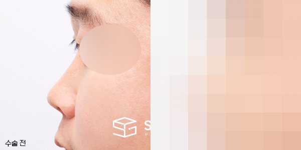 슈가성형외과 첫) 콧대코끝 + 매부리 + 비중격 + 귀연골 전후사진 - 45도 수술 전후 비교