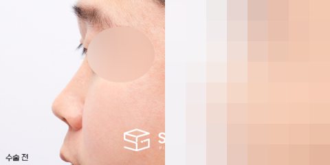 슈가성형외과 첫) 콧대코끝 + 매부리 + 비중격 + 귀연골 전후사진 - 45도 수술 전후 비교
