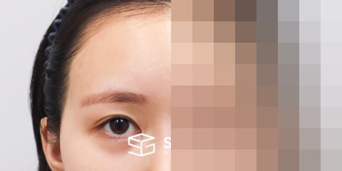 슈가성형외과 재) 이마거상 + 뒷트임 재수술 + 밑트임 + 애교필러 전후사진 - 정면 수술 전후 비교