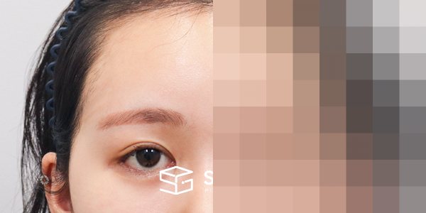 슈가성형외과 재) 이마거상 + 뒷트임 재수술 + 밑트임 + 애교필러 전후사진 - 45도 수술 전후 비교
