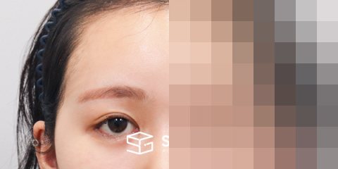 슈가성형외과 재) 이마거상 + 뒷트임 재수술 + 밑트임 + 애교필러 전후사진 - 45도 수술 전후 비교