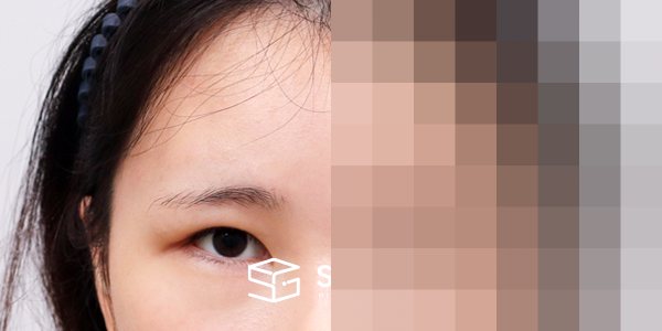 슈가성형외과 재) 이마거상 + 밑트임 재수술 전후사진 - 정면 수술 전후 비교