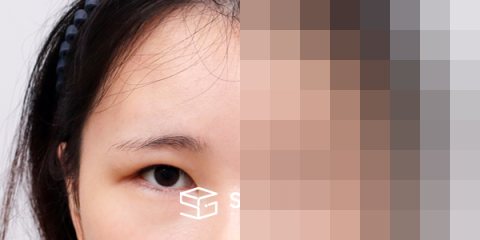 슈가성형외과 재) 이마거상 + 밑트임 재수술 전후사진 - 정면 수술 전후 비교