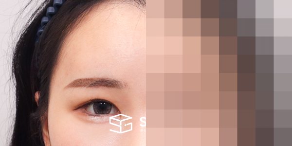 슈가성형외과 재) 이마거상 + 밑트임 재수술 전후사진 - 45도 수술 전후 비교
