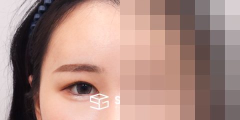 슈가성형외과 재) 이마거상 + 밑트임 재수술 전후사진 - 45도 수술 전후 비교
