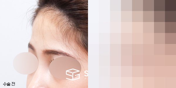 슈가성형외과 첫) 이마필러 전후사진 - 정면 수술 전후 비교