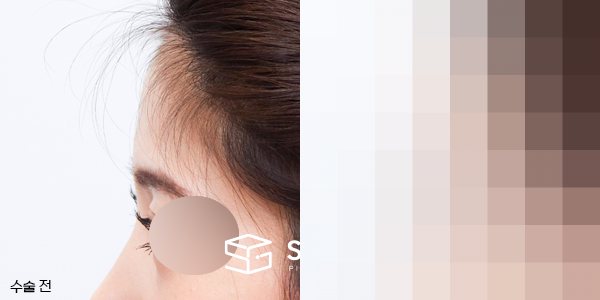 슈가성형외과 첫) 이마필러 전후사진 - 45도 수술 전후 비교