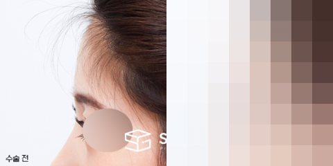 슈가성형외과 첫) 이마필러 전후사진 - 45도 수술 전후 비교