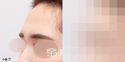 슈가성형외과 첫) 이마필러 전후사진 - 정면 수술 전후 비교