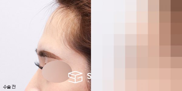 슈가성형외과 첫) 이마필러 전후사진 - 45도 수술 전후 비교