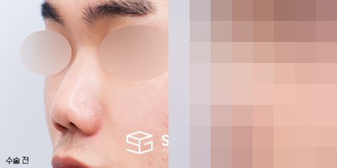 슈가성형외과 첫) 콧대코끝 + 매부리 + 복코 + 절골 + 기증늑 전후사진 - 정면 수술 전후 비교