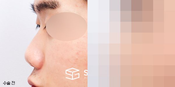슈가성형외과 첫) 콧대코끝 + 매부리 + 복코 + 절골 + 기증늑 전후사진 - 45도 수술 전후 비교