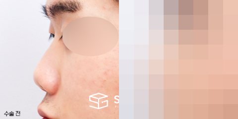 슈가성형외과 첫) 콧대코끝 + 매부리 + 복코 + 절골 + 기증늑 전후사진 - 45도 수술 전후 비교