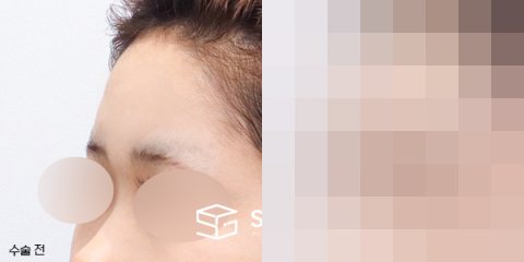 슈가성형외과 첫) 이마필러 전후사진 - 정면 수술 전후 비교