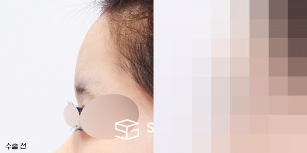 슈가성형외과 첫) 이마필러 전후사진 - 45도 수술 전후 비교