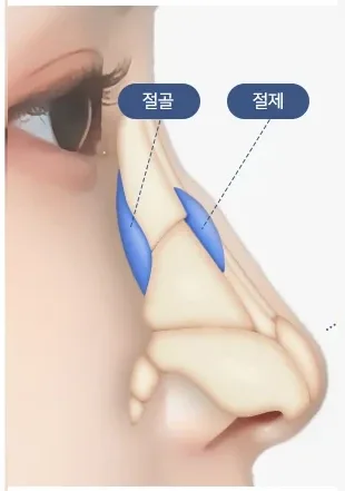 わし鼻 CASE3 骨切り
