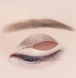 절개 눈매교정 3단계 — 라인 형성·봉합
