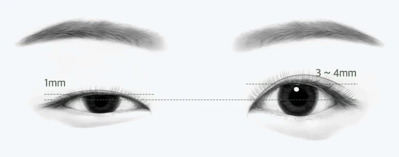 안검하수 눈(1mm)과 정상 눈(3~4mm) 비교 일러스트