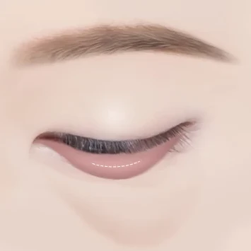 눈밑지방재배치 2단계 — 결막 절개
