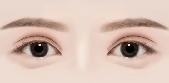 쌍꺼풀 라인이 심하게 두꺼운 경우