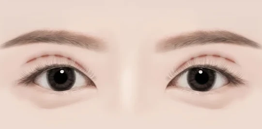 쌍꺼풀의 흉터가 심한 경우