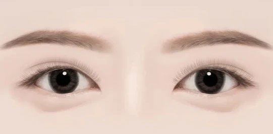 쌍꺼풀의 모양이 비대칭인 경우