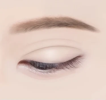 두줄따기 눈 재수술 — 수술 후 6개월 경과