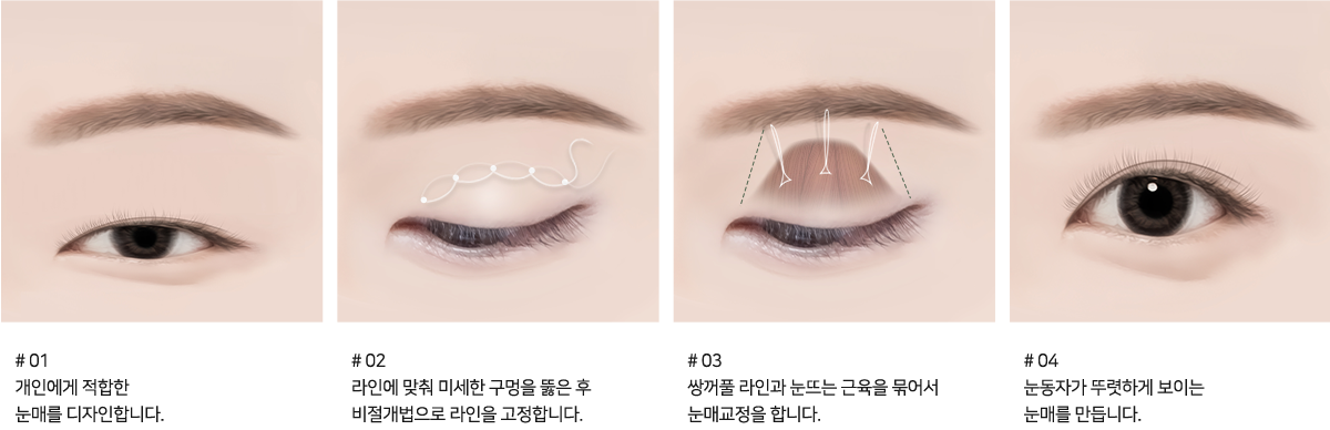 # 비절개 눈매교정 수술방법