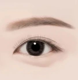 앞트임 수술방법 04 완성