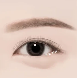 밑트임 수술방법 03 봉합