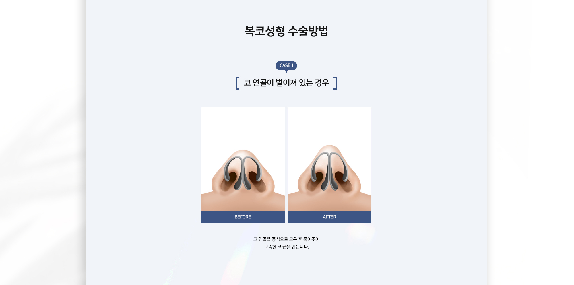 복코성형 수술방법 CASE 1