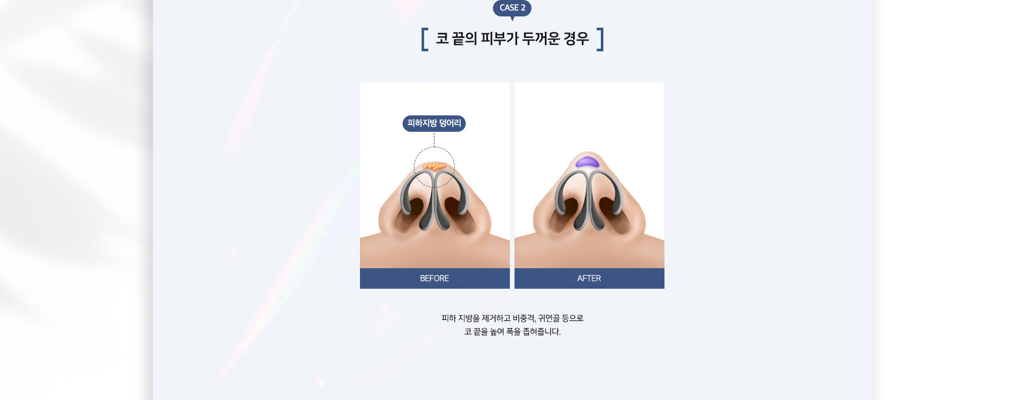 복코성형 수술방법 CASE 2