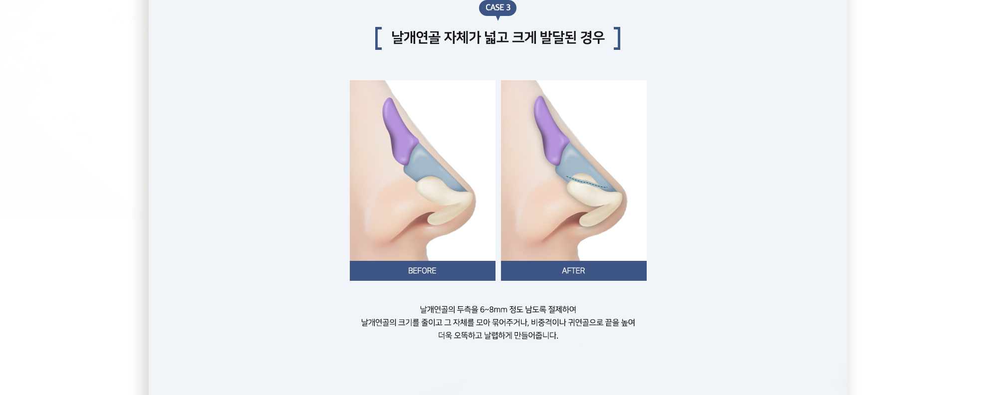 복코성형 수술방법 CASE 3