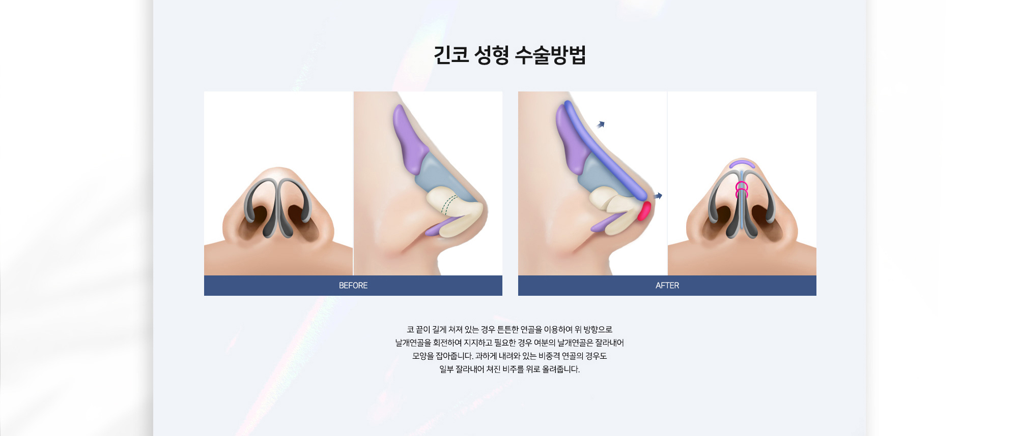 긴코 성형 수술방법