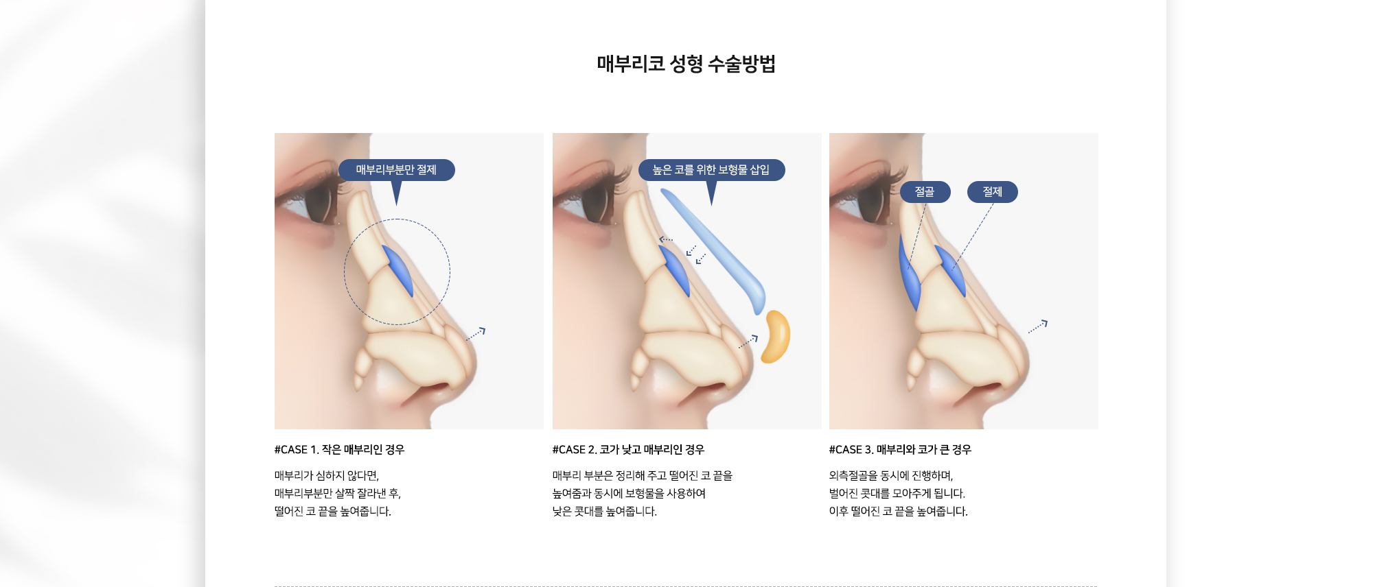 매부리코 성형 수술 방법