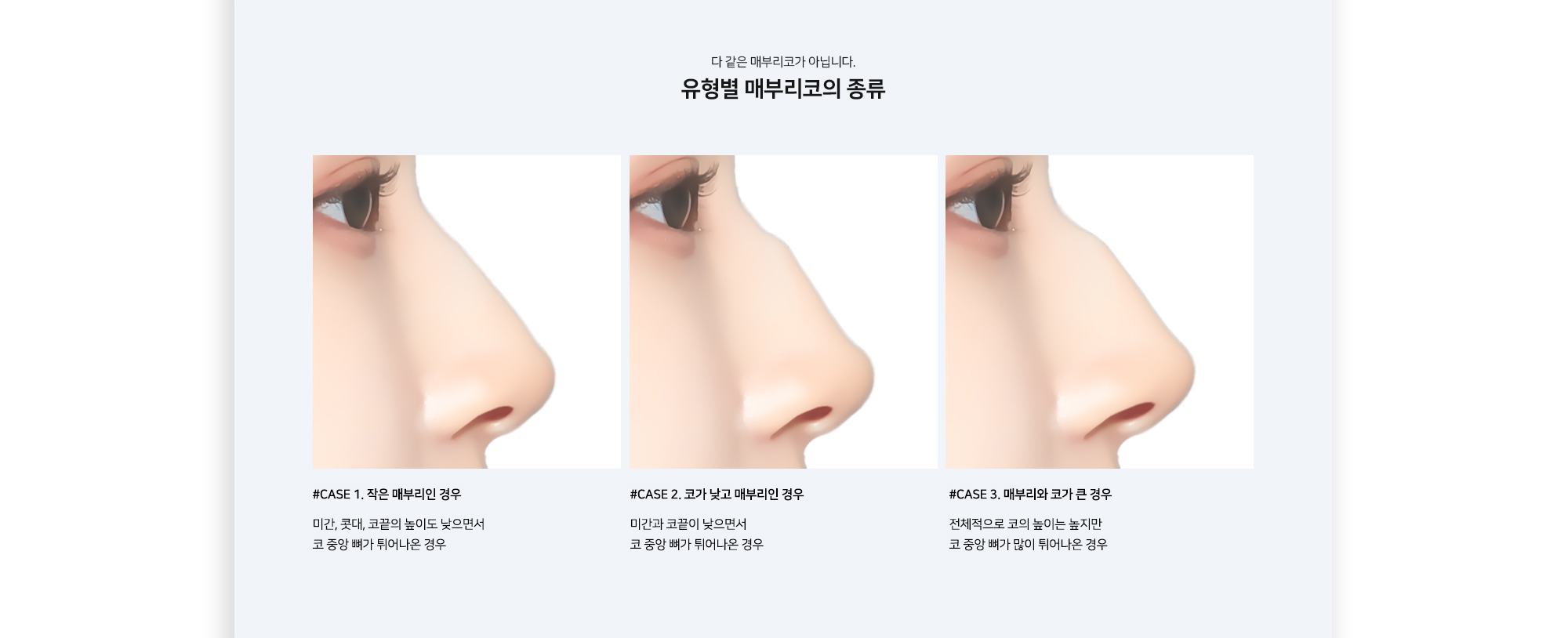 유형별 매부리코의 종류