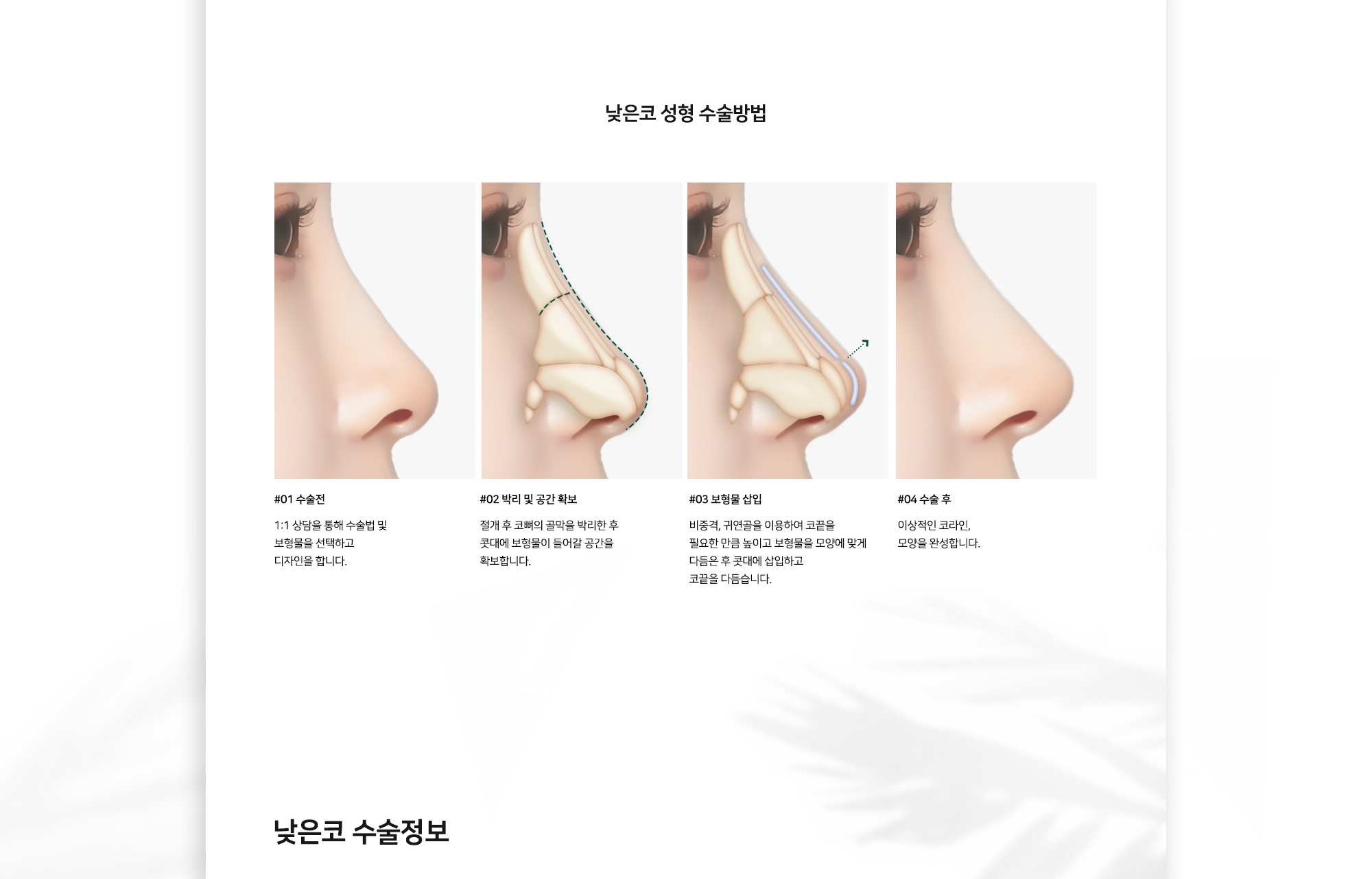 낮은코 성형 수술방법