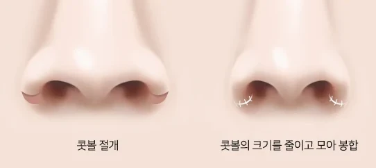 절개 콧볼축소 — 콧볼 절개 후 크기를 줄이고 모아 봉합