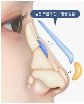 매부리코 CASE2 보형물 삽입