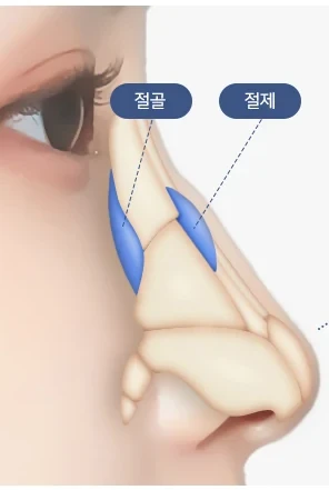 매부리코 CASE3 절골