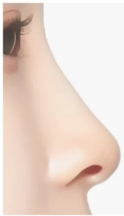 낮은코 성형 01 수술 전