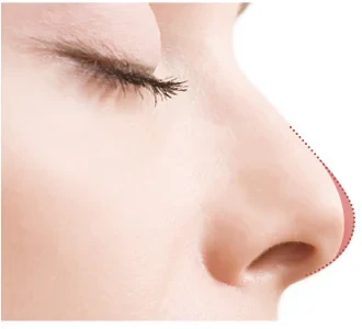 코재수술 원인 — 코 끝이 낮아지는 경우