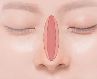 코재수술 원인 — 콧폭이 너무 넓거나 좁은 경우